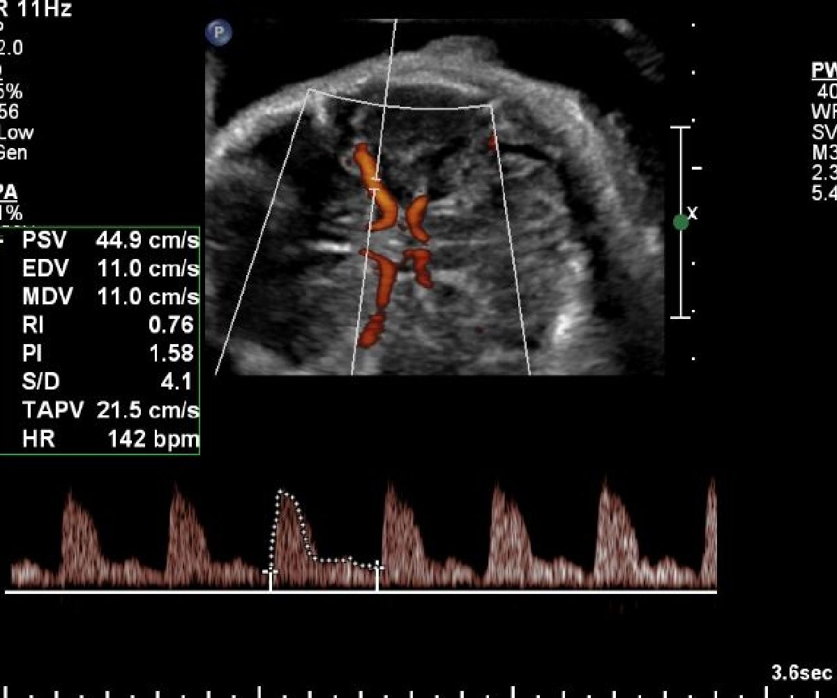 Ultrazvučni i kolor dopler pregled protoka krvi kroz mozak fetusa